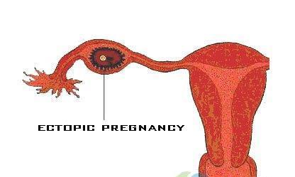 根据hcg，什么是宫外孕？