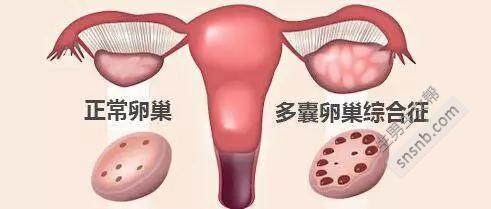 多囊卵巢综合症是什么鬼？我不能怀孕吗？